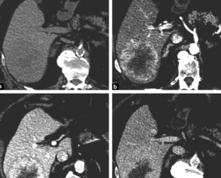 Pilier du diagnostic non invasif du carcinome hépatocellulaire, le LI-RADS repose sur des critères majeurs dont les combinaisons sont utilisées quotidiennement en pratique. Pourtant, la contribution diagnostique respective de ces associations reste discutée, notamment aux frontières entre les catégories. Des travaux récents viennent préciser la performance réelle de ces combinaisons et interrogent l’applicabilité du LI-RADS au-delà de sa population cible historique.