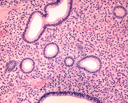 IRM et invasion lymphovasculaire : un marqueur simple pour affiner le staging chirurgical du cancer de l’endomètre 