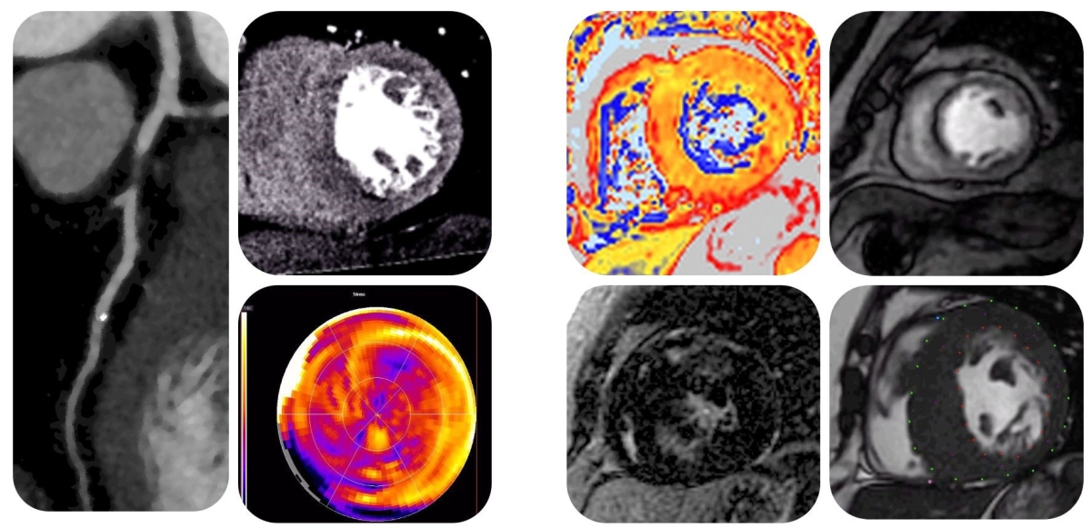 cardiovascular ct