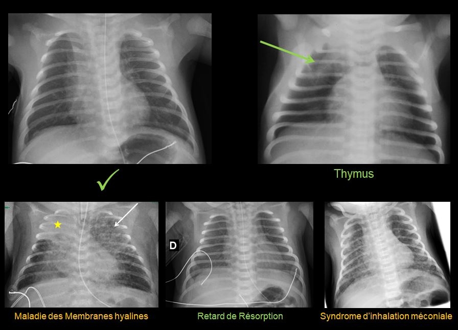 Figure 1 SFR thorax.JPG