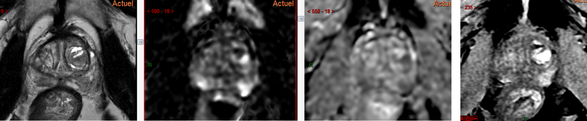 prostate