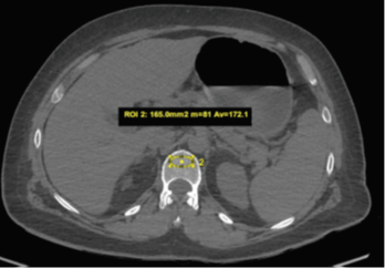 Mise en place d’une ROI dans le corps vertébral de L1 sur une scanner abdominal réalisé pour une douleur abdominale, permettant une mesure de la DMO en UH : la DMO est mesurée à 172,1 UH en faveur de l’absence d’ostéoporose. 