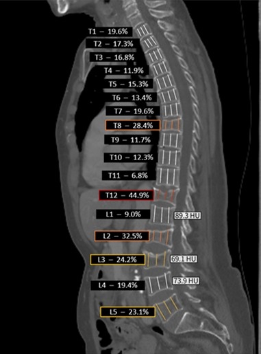 Logiciel d’IA permettant une détection systématique et automatique des fractures vertébrales et mesurant la DMO en UH de façon automatisée sur un scanner TAP réalisé pour une autre indication : patiente ostéoporotique présentant de nombreuses fracture vertébrales. 