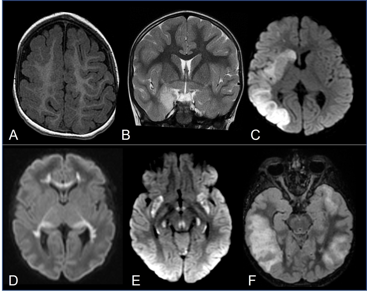 encephalite