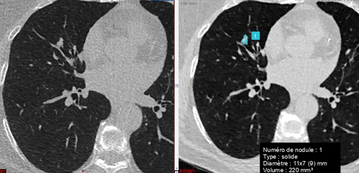 cancer pulmonaire