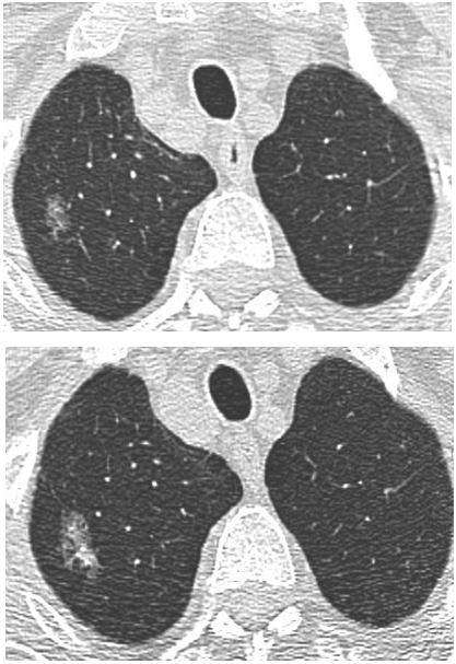 Nodules pulmonaires : trucs et astuces | SFR