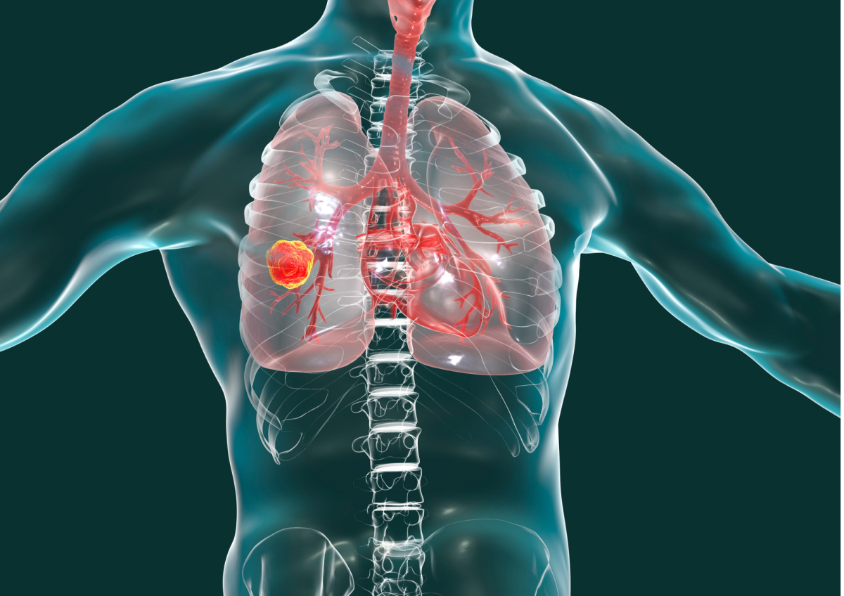 Cycle de formations au dépistage du cancer du poumon par scanner ...