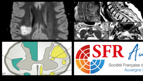SFAR AURA - Ateliers de NEURO-RADIOLOGIE