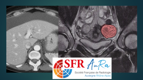 SFR AURA - Le radiologue en première ligne dans la prise en charge des CANCERS  DE L´OVAIRE