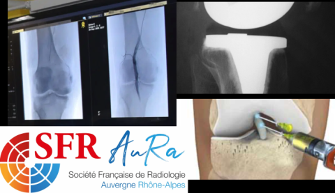 SFR AURA - NOUVEAUTES dans la prise en charge des douleurs du GENOU dégénératif et prothétique