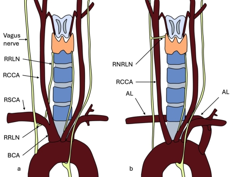 Arteria lusoria 1.jpg