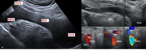 Arteria lusoria 2.jpg