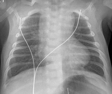 Bronchiolite-Image1