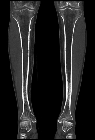 Image CT coronale epaississement.png