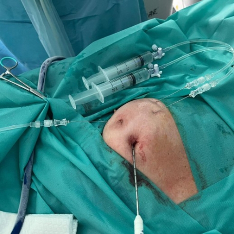 Cryoablation