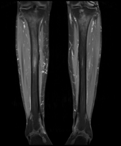 Séquence coronale T1 avec supprression.png