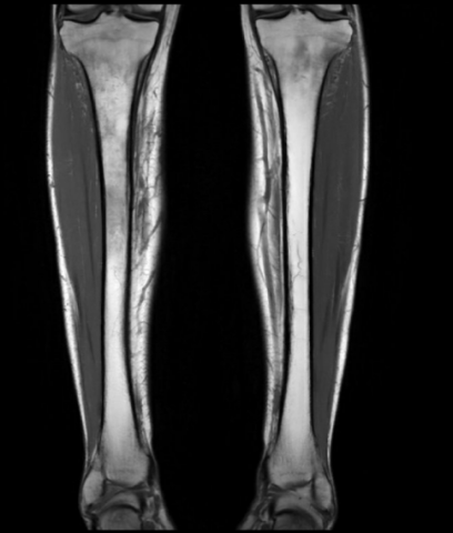 Séquence coronale pondérée en T1.png
