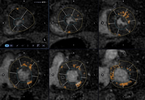 irm cardiaque