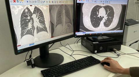 Formation au dépistage du cancer du poumon par scanner faible dose 