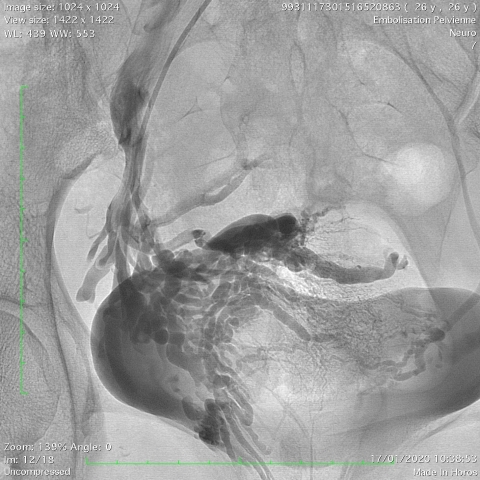 embolisation pelvienne