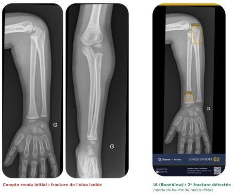 BoneView